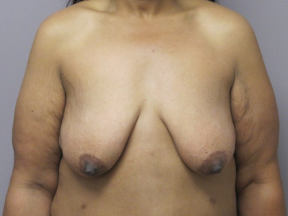 Breast Lift Before & After Patient #1714