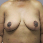 Breast Lift Before & After Patient #1714