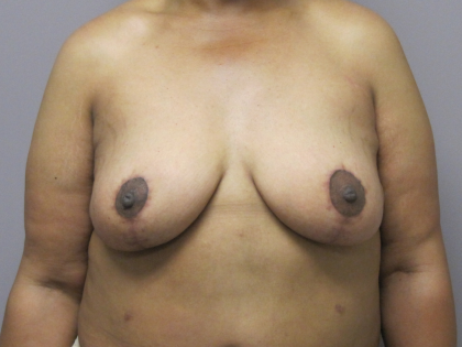 Breast Lift Before & After Patient #1714