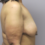 Breast Lift Before & After Patient #1714