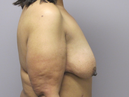 Breast Lift Before & After Patient #1714