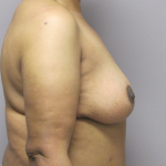 Breast Lift Before & After Patient #1714