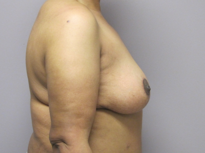 Breast Lift Before & After Patient #1714