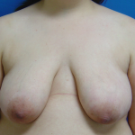 Breast Lift Before & After Patient #1713