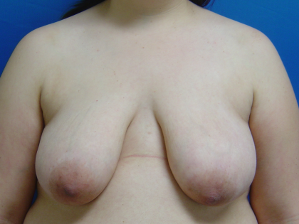 Breast Lift Before & After Patient #1713