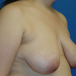 Breast Lift Before & After Patient #1713