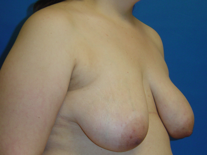 Breast Lift Before & After Patient #1713