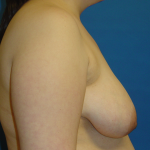 Breast Lift Before & After Patient #1713