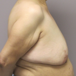 Breast Lift Before & After Patient #1712