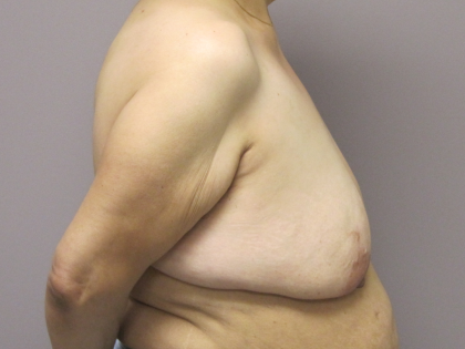 Breast Lift Before & After Patient #1712