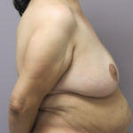 Breast Lift Before & After Patient #1712