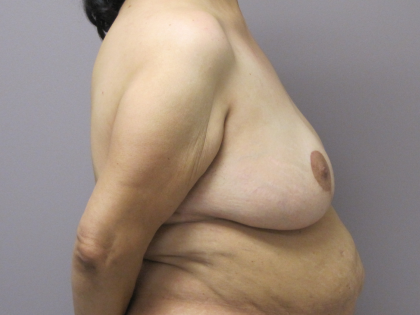 Breast Lift Before & After Patient #1712