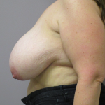 Breast Lift Before & After Patient #1711