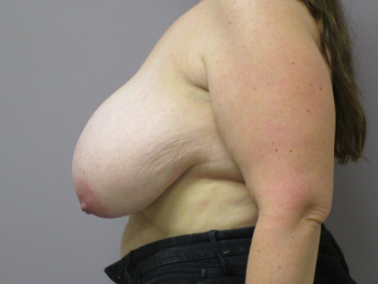 Breast Lift Before & After Patient #1711