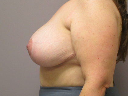 Breast Lift Before & After Patient #1711