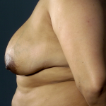 Breast Lift Before & After Patient #1709