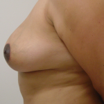 Breast Lift Before & After Patient #1709