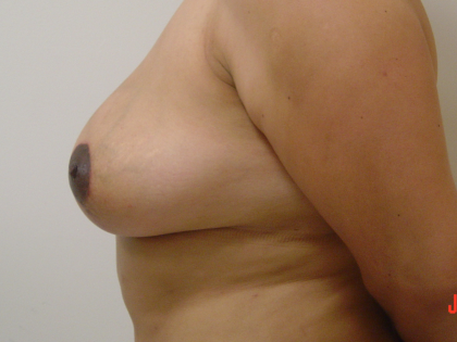 Breast Lift Before & After Patient #1709