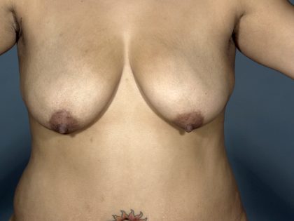 Breast Lift Before & After Patient #1708