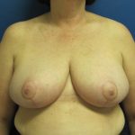 Breast Reduction Before & After Patient #1728