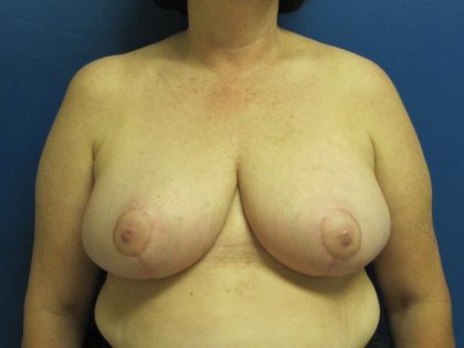 Breast Reduction Before & After Patient #1728