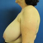 Breast Reduction Before & After Patient #1728