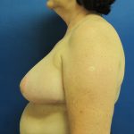 Breast Reduction Before & After Patient #1728