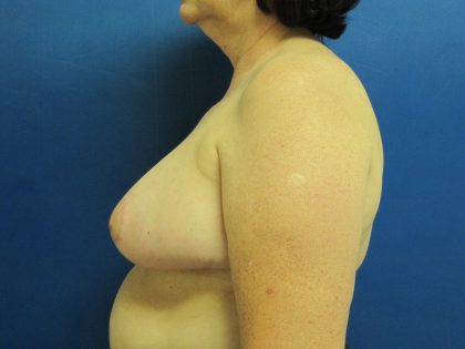 Breast Reduction Before & After Patient #1728