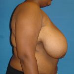 Breast Reduction Before & After Patient #1727