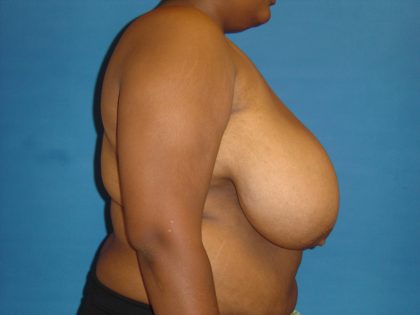 Breast Reduction Before & After Patient #1727