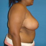 Breast Reduction Before & After Patient #1727