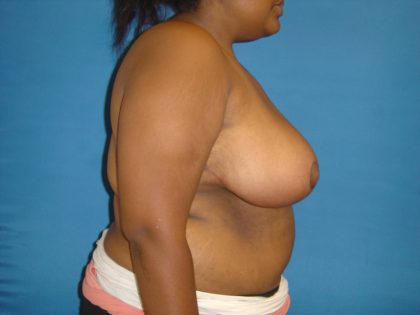 Breast Reduction Before & After Patient #1727