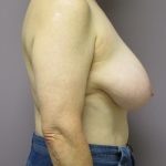 Breast Reduction Before & After Patient #1726