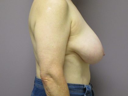 Breast Reduction Before & After Patient #1726