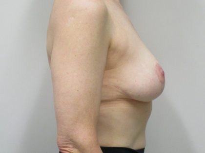 Breast Reduction Before & After Patient #1726