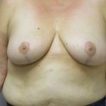 Breast Reduction Before & After Patient #1724