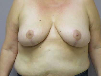 Breast Reduction Before & After Patient #1724