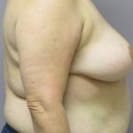 Breast Reduction Before & After Patient #1724