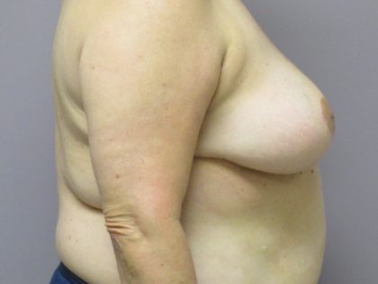 Breast Reduction Before & After Patient #1724