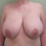 Breast Reduction Before & After Patient #1723