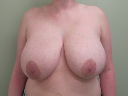 Breast Reduction Before & After Patient #1723