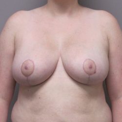 Breast Reduction Before & After Patient #1723