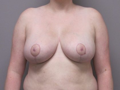 Breast Reduction Before & After Patient #1723