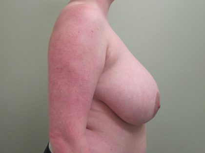 Breast Reduction Before & After Patient #1723