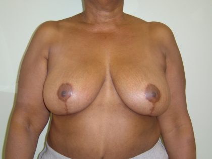 Breast Reduction Before & After Patient #1722