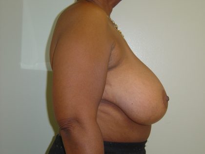 Breast Reduction Before & After Patient #1722