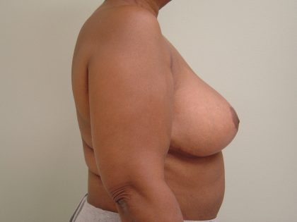 Breast Reduction Before & After Patient #1722