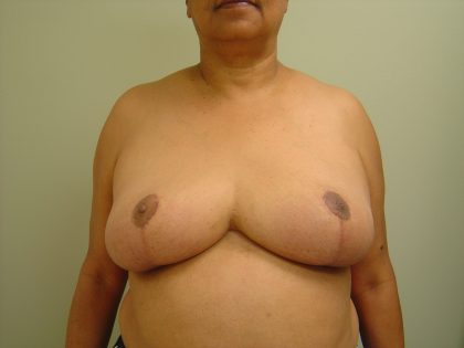 Breast Reduction Before & After Patient #1721