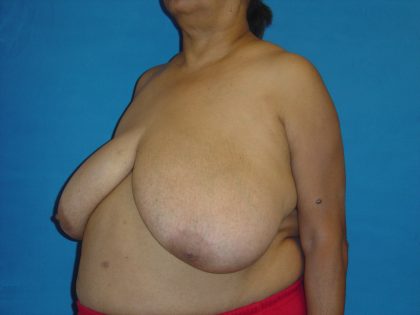 Breast Reduction Before & After Patient #1721