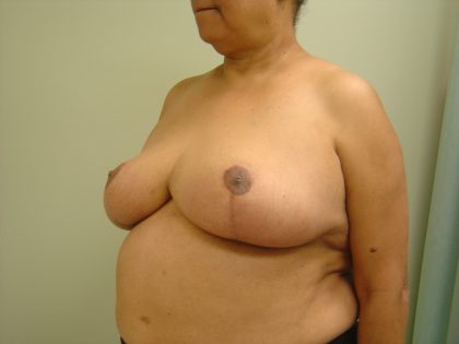 Breast Reduction Before & After Patient #1721